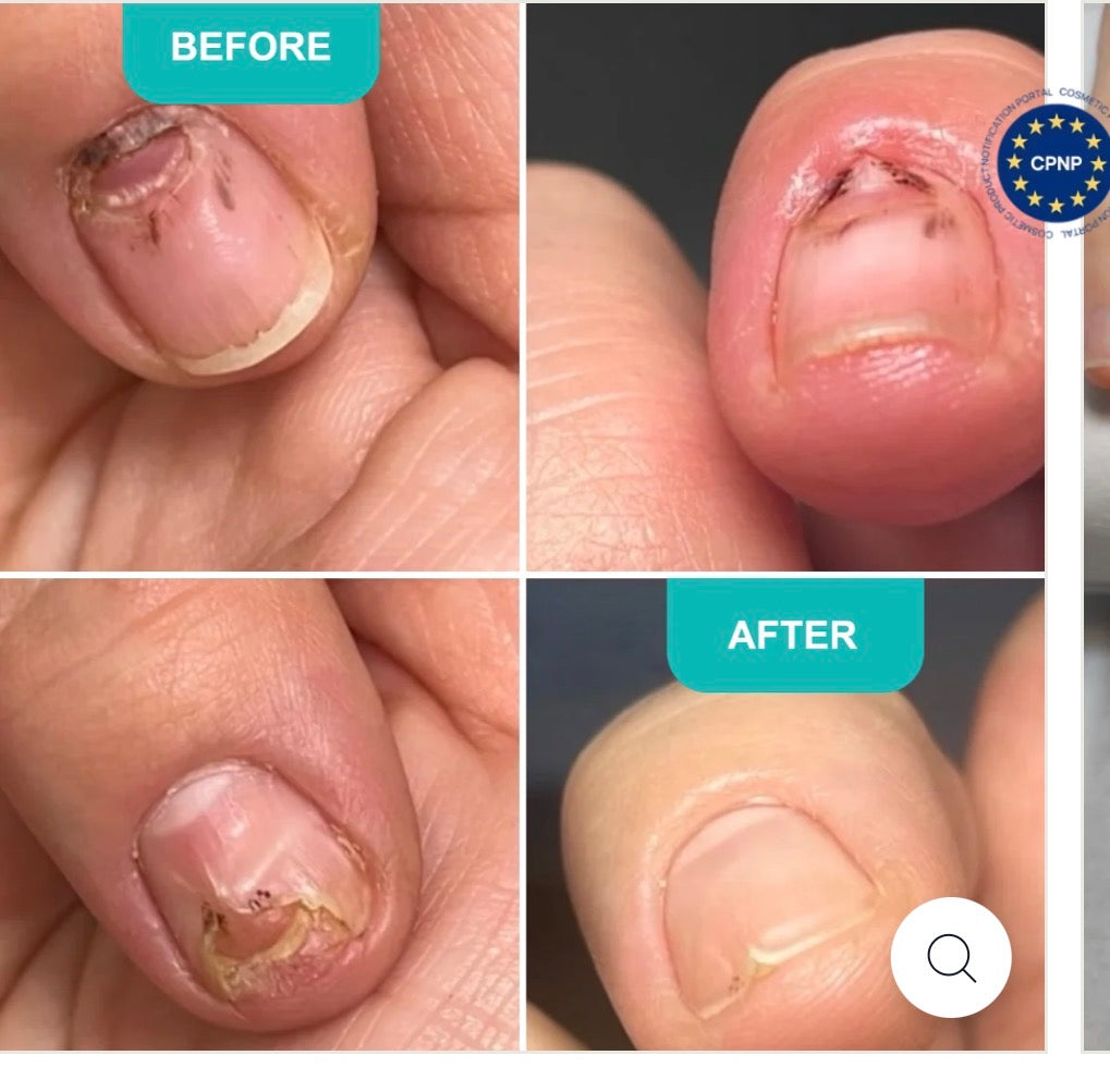 Aceite para uñas dañadas Stop Onycholysis (Detén la onicólisis) Shelly, 30 ml